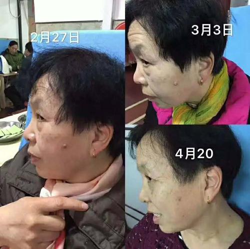 治療儀招商 治療儀招商